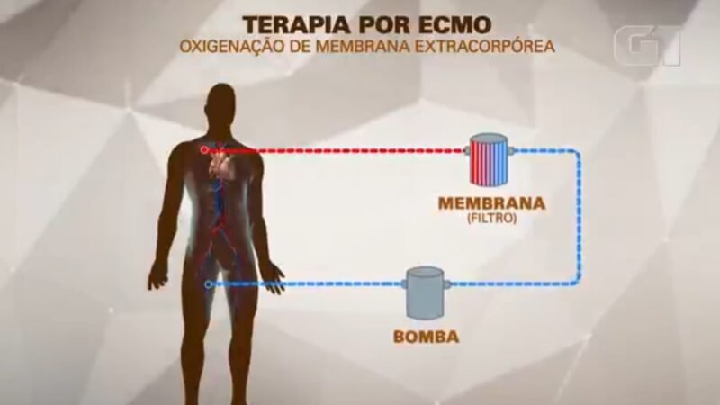 MC Marcinho usa terapia conhecida como ECMO, espécie de pulmão artificial; entenda como funciona