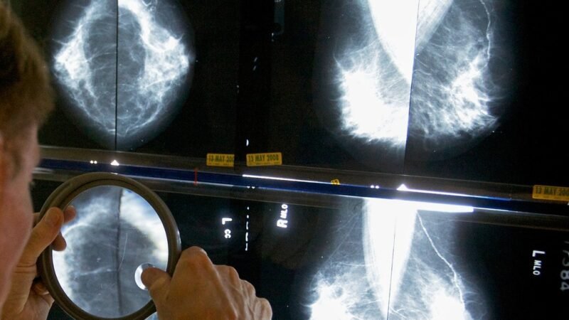 Casos de câncer de mama podem chegar a 3,5 mi por ano até 2050; mortalidade cai em países ricos e dispara em nações pobres