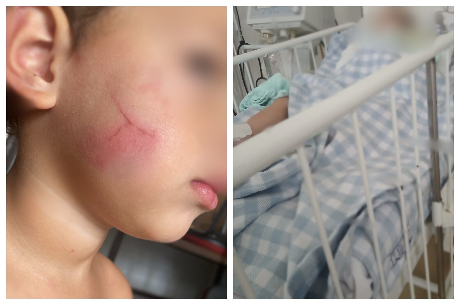 Bebê é internado com hemorragia e traumatismo craniano; irmão de 3 anos relata agressão de babá
