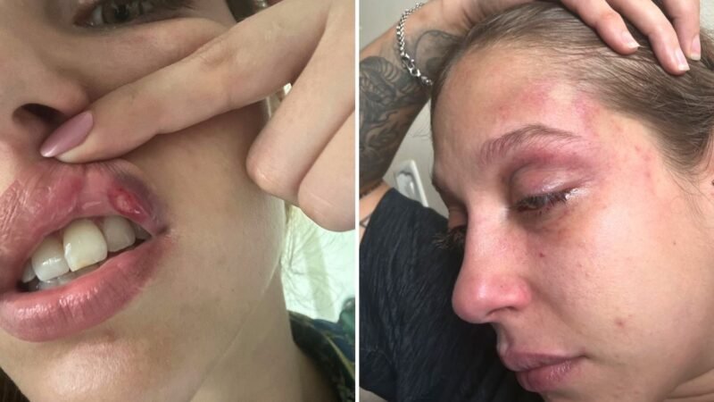 Jovem que denunciou ter sido espancada com socos por empresário foi socorrida com a boca sangrando e dentes quebrados, diz polícia