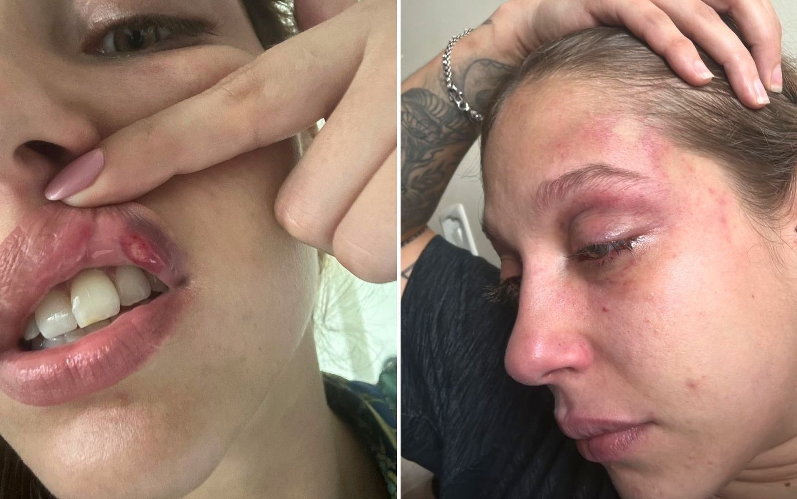 Jovem que denunciou ter sido espancada com socos por empresário foi socorrida com a boca sangrando e dentes quebrados, diz polícia