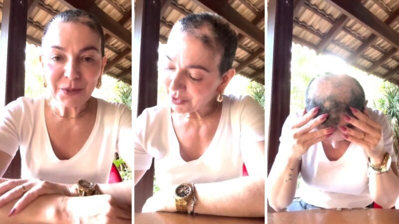 Alopecia areata: doença que fez mãe de Lucas Lucco perder cabelo tem tratamento de alto custo e afeta a saúde mental