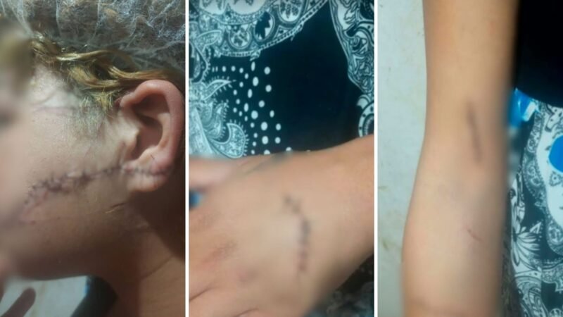 Ex-marido é preso suspeito de cortar o rosto e orelha de mulher; imagem forte