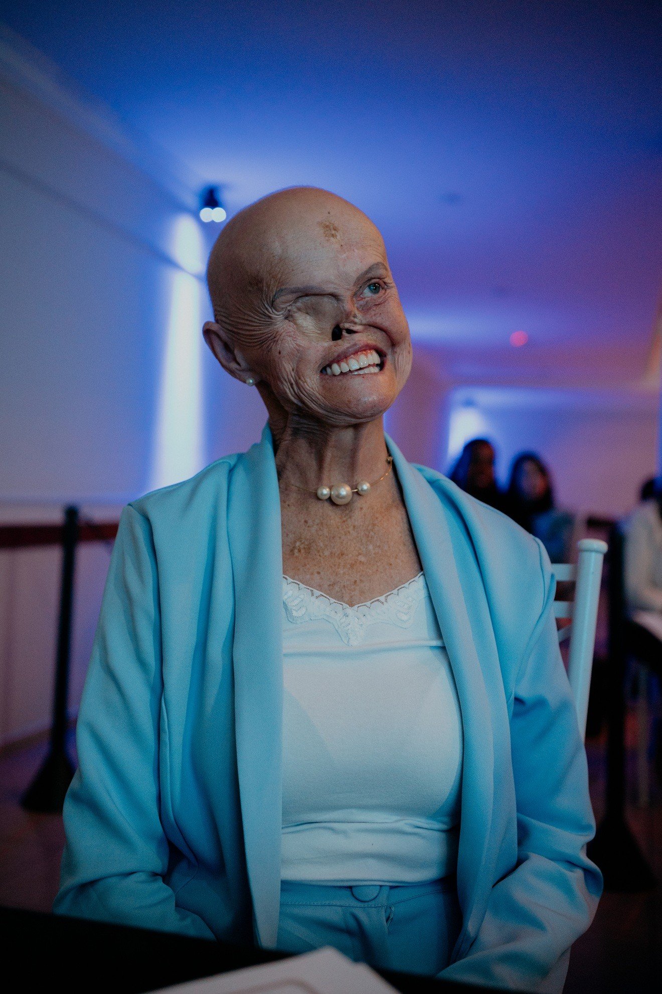 Mulher com síndrome genética rara já teve 73 cânceres de pele e espera cirurgia para reconstruir o nariz
